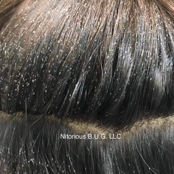 Does Your Client Have Lice? This Is What To Do 