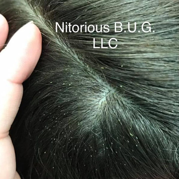 lice and/or nits on scalp and hair