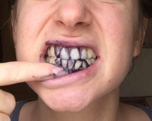 A Purple Shampoo For Teeth? See the Shocking Befores & Afters!-img