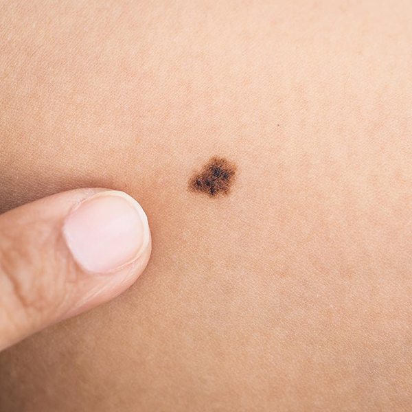 Skin Cancer Spots