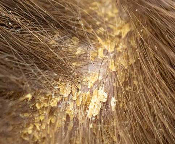 head scalp fungus