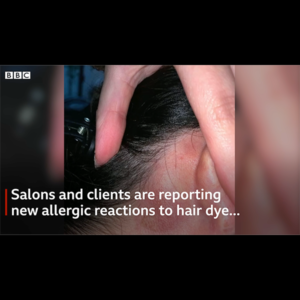 COVID-19: Can It Cause Allergic Reactions to Haircolor?