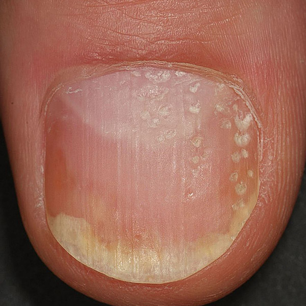 Nail Pitting Non-specific sign for psoriasis (additional ... | GrepMed