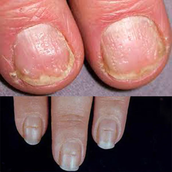 healthline mayoclinic nail pitting holes in nails article health