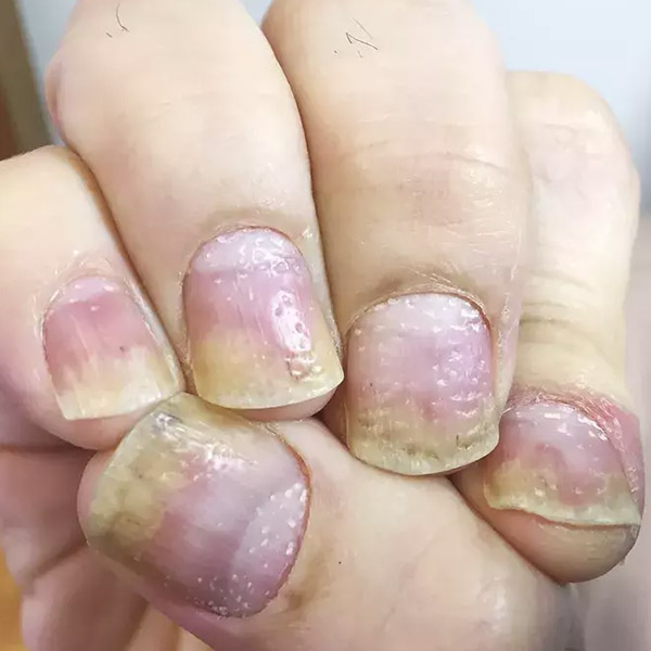 Are You Seeing Holes & Dents In Nails? Read This!