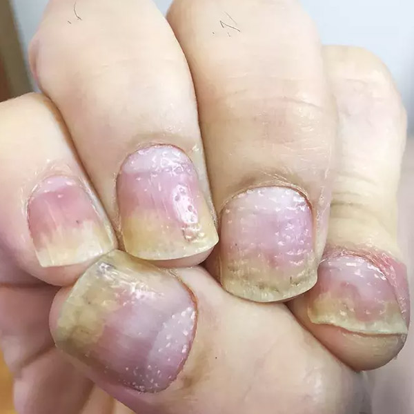 what-that-weird-dent-or-blotch-on-your-nail-might-be-saying-about-your